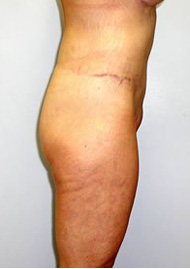 Thigh Lift Before & After Image