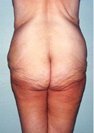 Thigh Lift Before & After Image