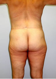 Thigh Lift Before & After Image