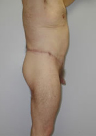 Thigh Lift Before & After Image