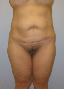 Thigh Lift Before & After Image