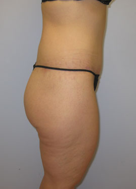 Thigh Lift Before & After Image