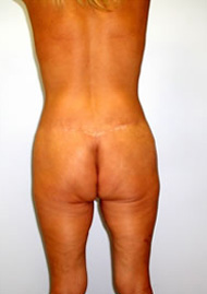 Thigh Lift Before & After Image