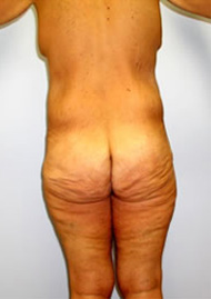 Thigh Lift Before & After Image