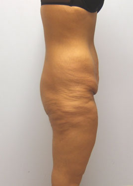 Thigh Lift Before & After Image