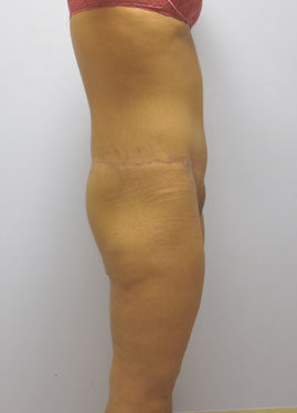 Thigh Lift Before & After Image