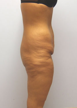 Thigh Lift Before & After Image