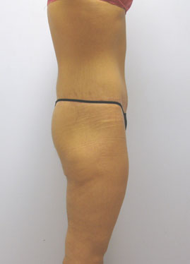 Thigh Lift Before & After Image