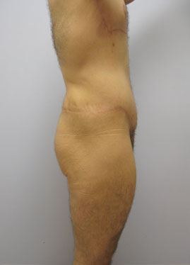 Thigh Lift Before & After Image