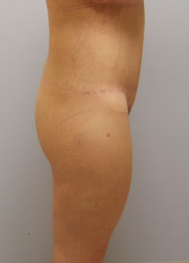 Thigh Lift Before & After Image