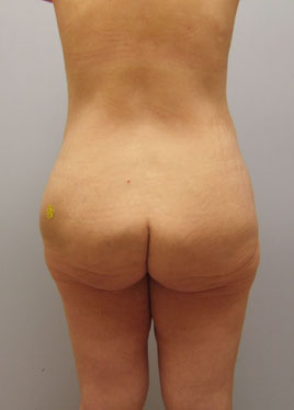 Thigh Lift Before & After Image