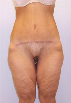 Thigh Lift Before & After Image