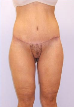 Thigh Lift Before & After Image