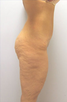 Thigh Lift Before & After Image