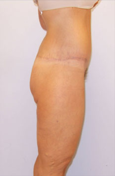 Thigh Lift Before & After Image