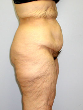 Thigh Lift Before & After Image