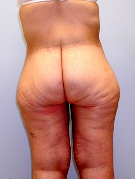 Thigh Lift Before & After Image