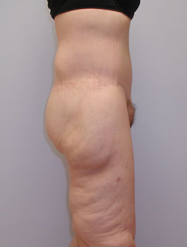 Thigh Lift Before & After Image