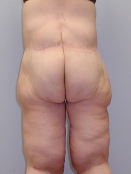 Thigh Lift Before & After Image