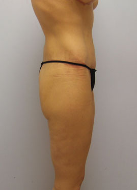 Thigh Lift Before & After Image