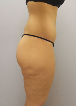 Thigh Lift Before & After Image