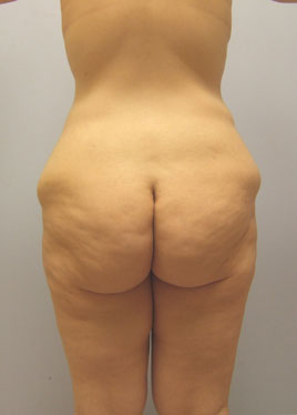 Thigh Lift Before & After Image