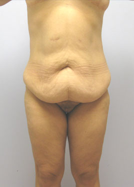 Thigh Lift Before & After Image