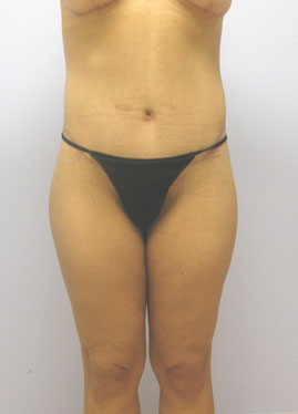 Thigh Lift Before & After Image