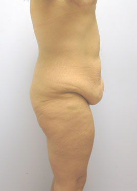 Thigh Lift Before & After Image