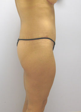 Thigh Lift Before & After Image