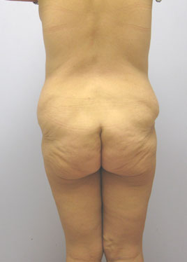 Thigh Lift Before & After Image