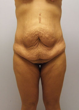 Thigh Lift Before & After Image