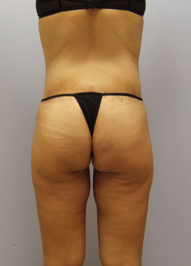 Thigh Lift Before & After Image