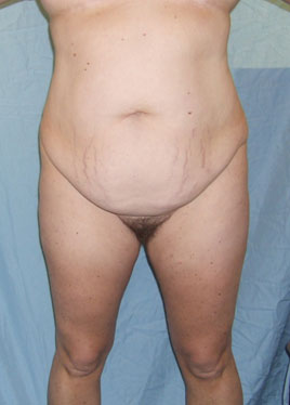 Thigh Lift Before & After Image