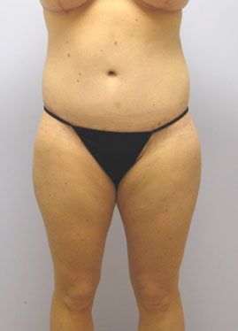 Thigh Lift Before & After Image