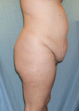 Thigh Lift Before & After Image