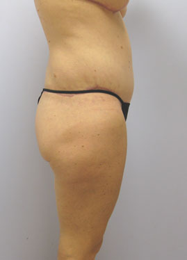 Thigh Lift Before & After Image