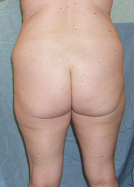 Thigh Lift Before & After Image