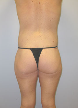 Thigh Lift Before & After Image