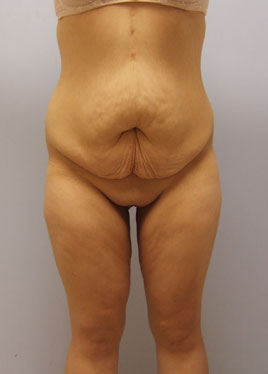 Thigh Lift Before & After Image