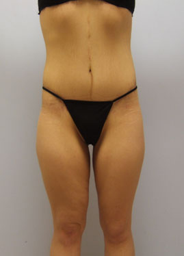 Thigh Lift Before & After Image