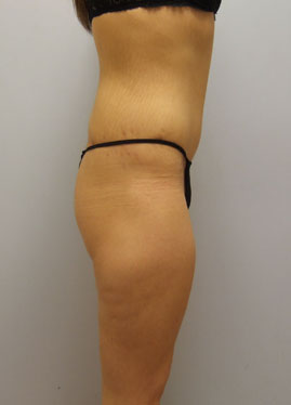 Thigh Lift Before & After Image