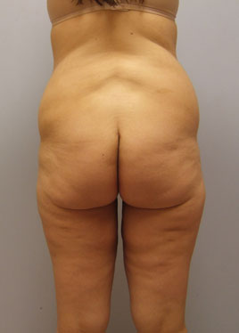 Thigh Lift Before & After Image