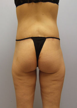 Thigh Lift Before & After Image