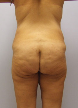 Thigh Lift Before & After Image