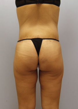 Thigh Lift Before & After Image