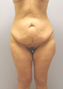 Thigh Lift Before & After Image