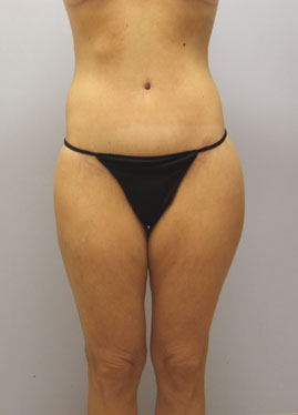 Thigh Lift Before & After Image