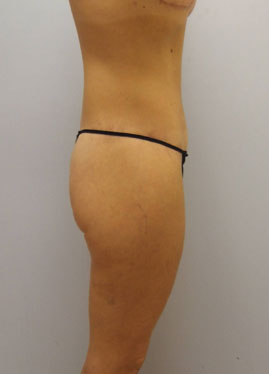 Thigh Lift Before & After Image