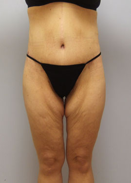 Thigh Lift Before & After Image